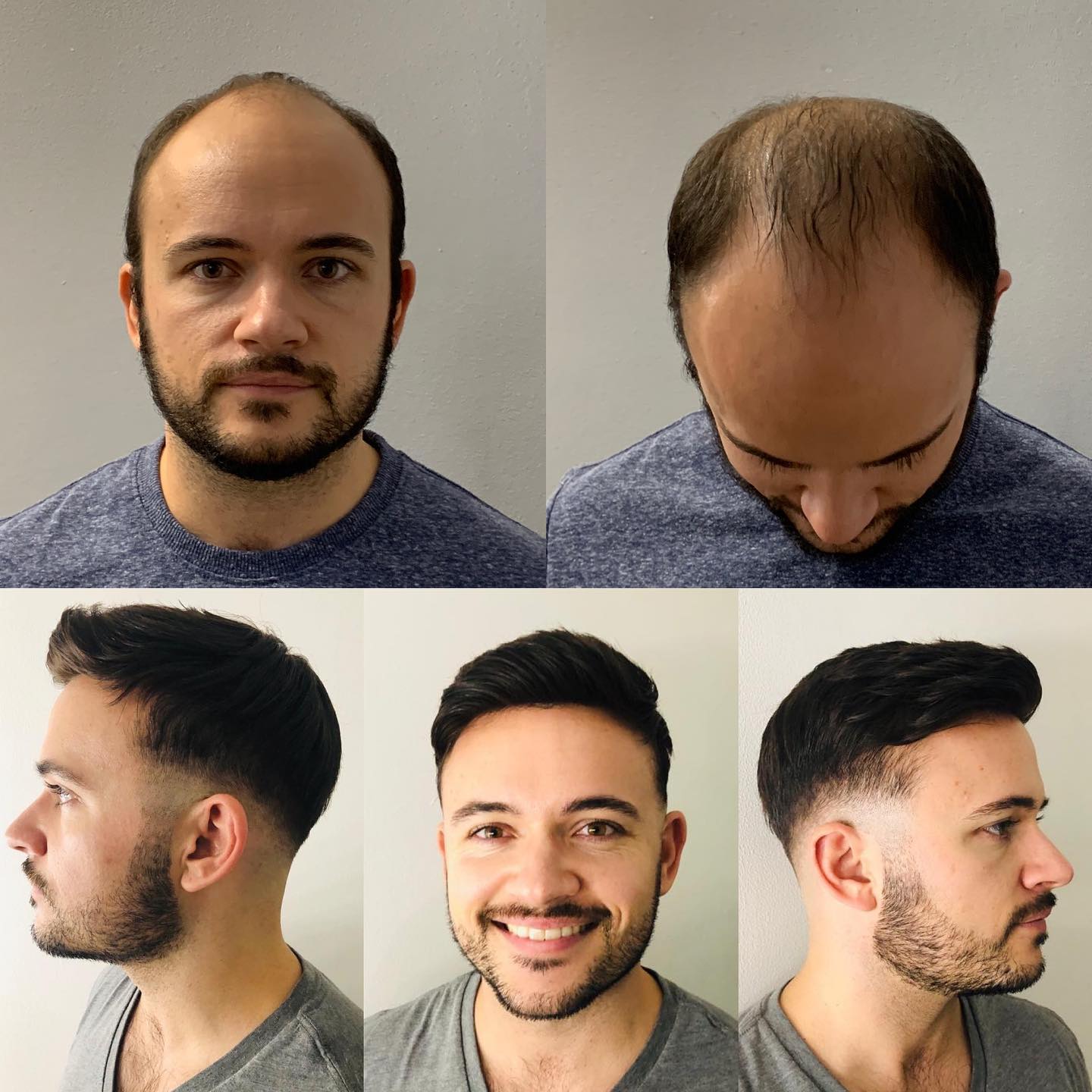 Hair Replacement Newport Wales | Hair Systems from £595