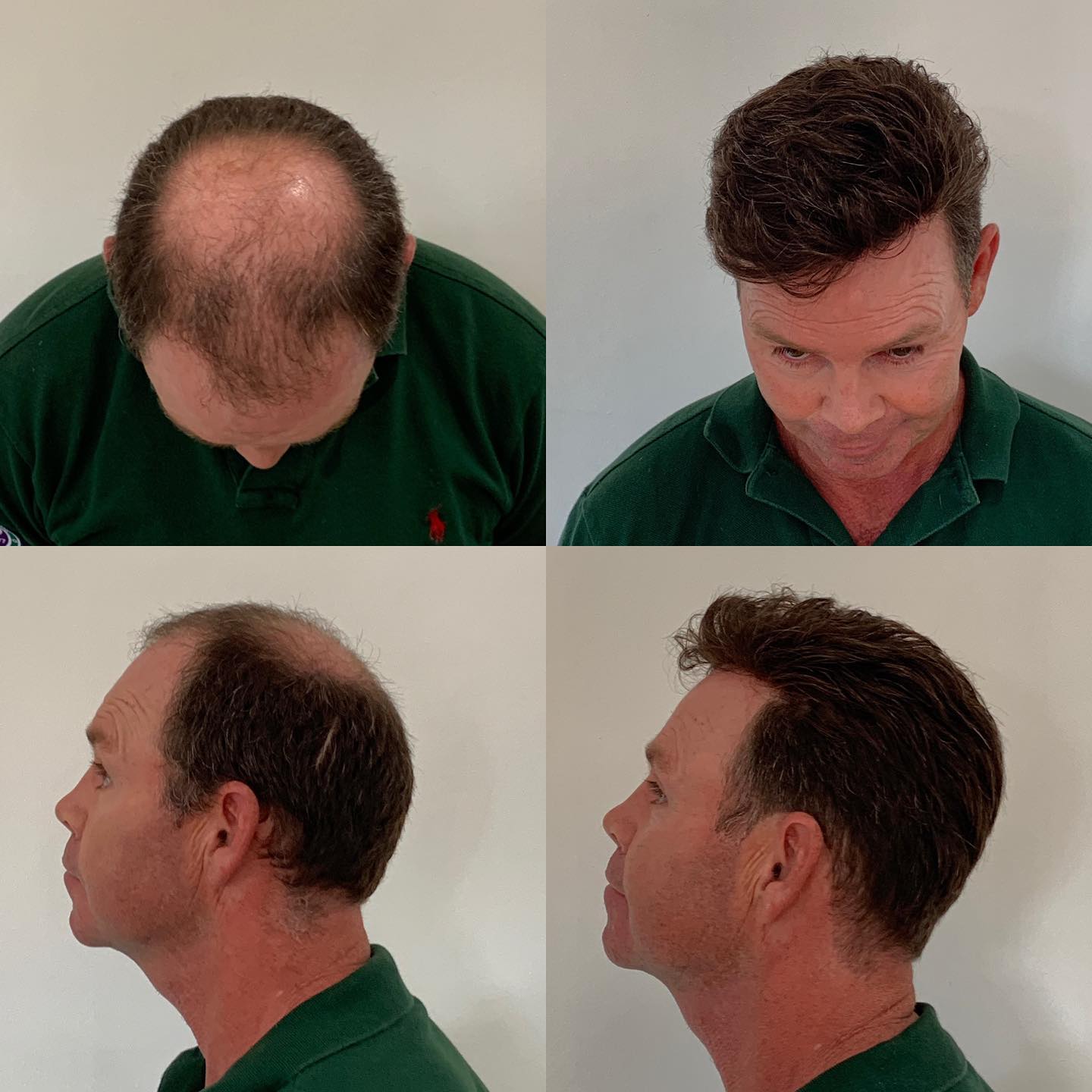 Hair Replacement Oxford | Hair Systems from £595