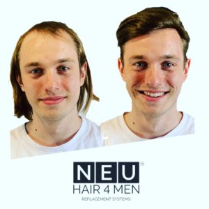Hair Replacement Southampton